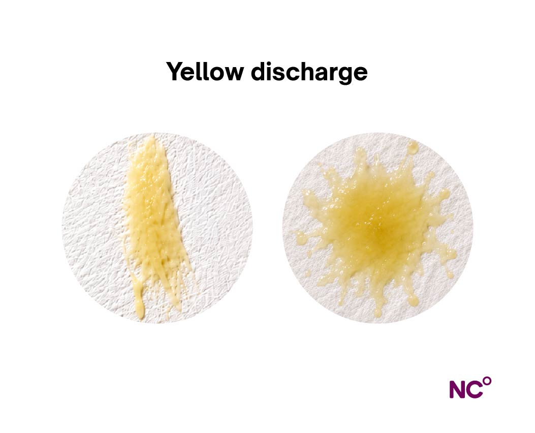 Is it normal for discharge to be yellow: main illustration