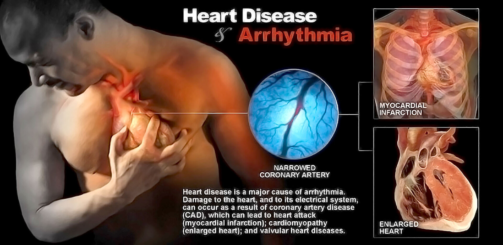 What causes and enlarged heart: example and key details