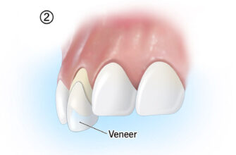 23522-dental-veneer