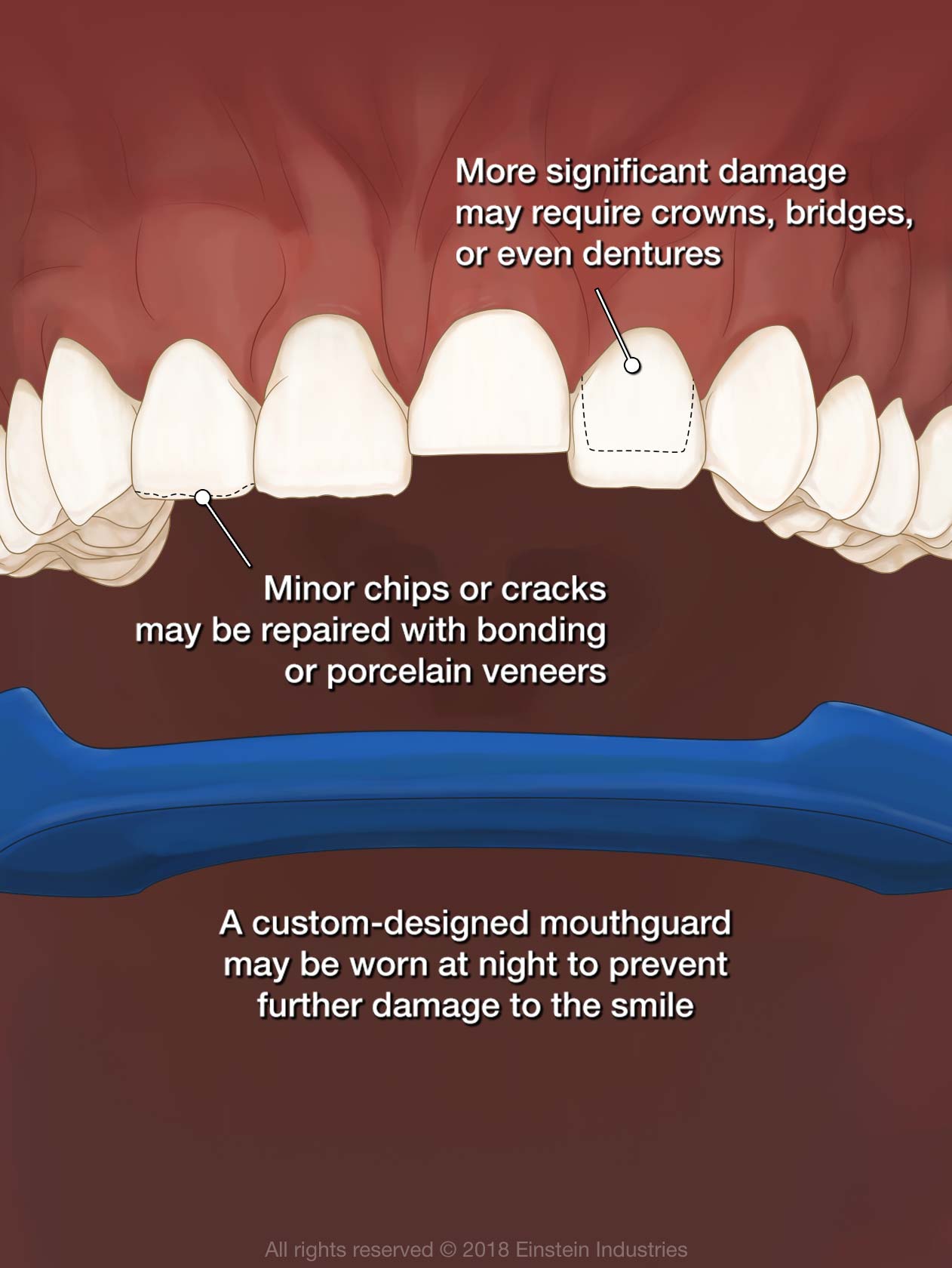 Why do i grind my teeth in sleep: visual explanation