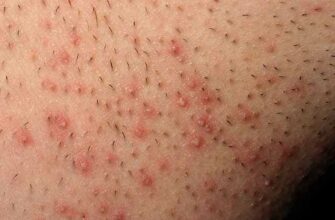 61.pseudofolliculitis-6-42a7ba88947f4cf499f72f2078502511