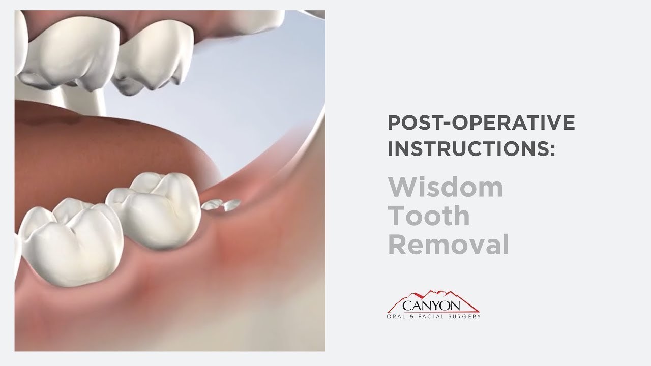 Can i brush my teeth after wisdom teeth pulled: main illustration