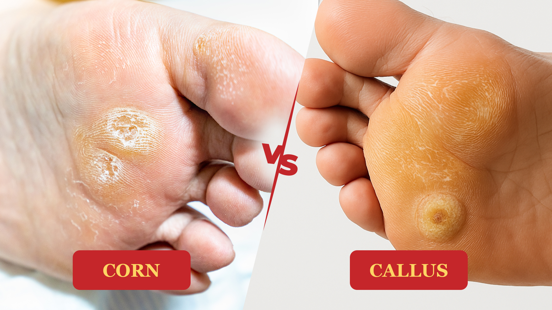 Difference between corns and calluses: main illustration