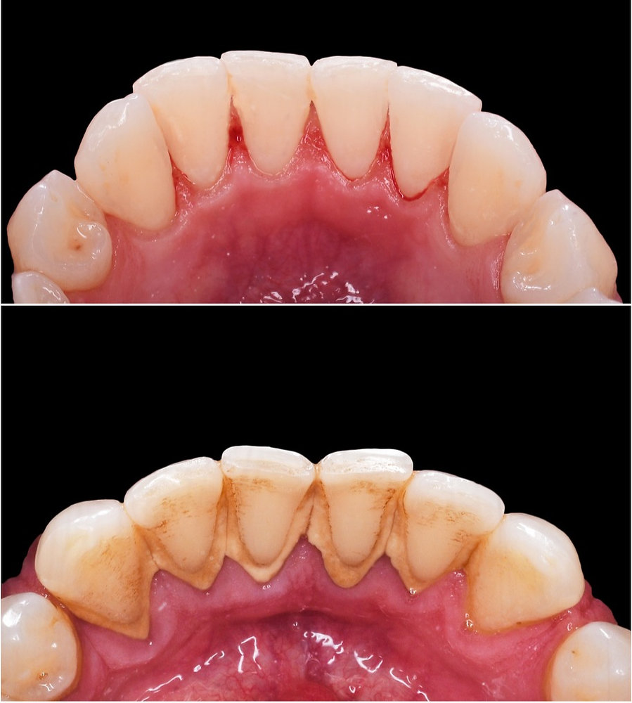 How long do teeth cleanings take: visual explanation