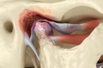 Temporomandibular,Joints,Arthritis,And,Dislocated,Articular,Disc.,Medically,Accurate,3d