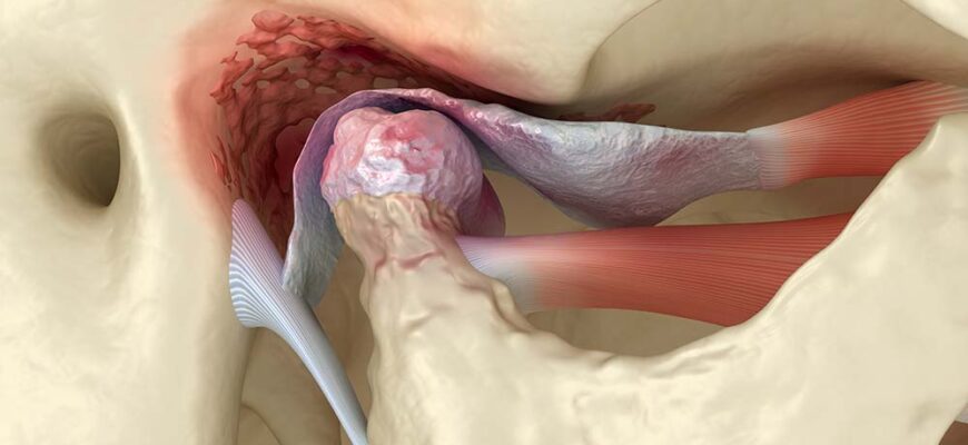 Temporomandibular,Joints,Arthritis,And,Dislocated,Articular,Disc.,Medically,Accurate,3d