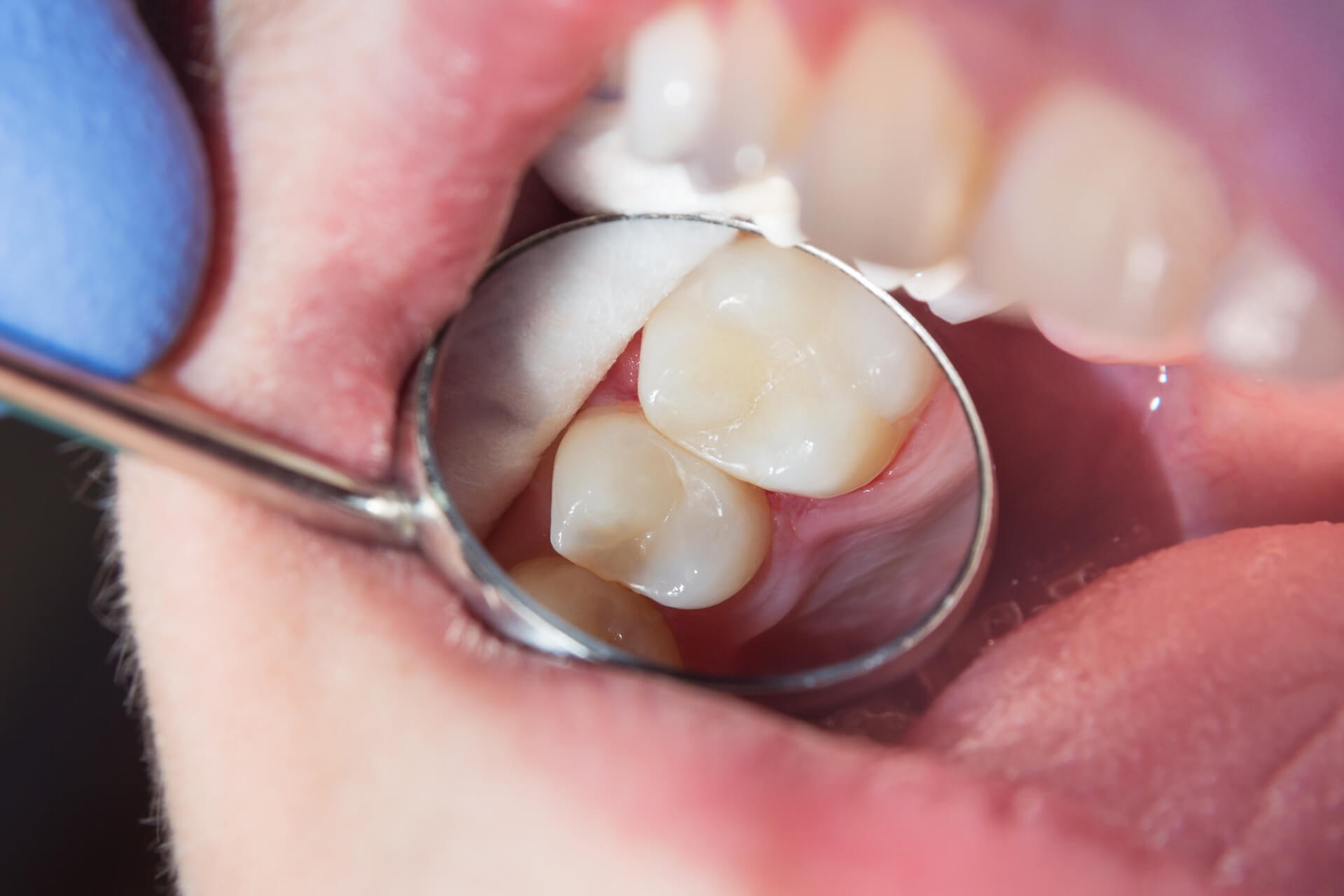 Why does my tooth filling hurt after months: main illustration