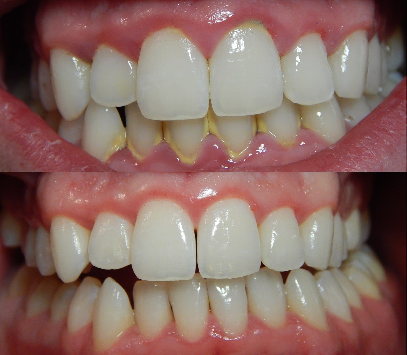 What are the gum disease: visual explanation