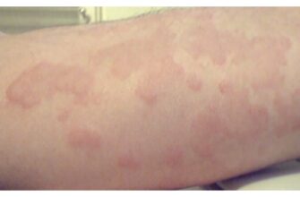 Hives-1296x728-gallery_10