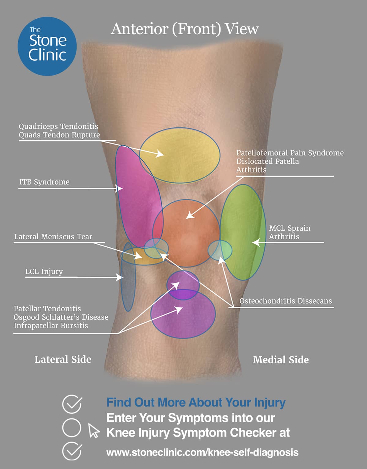 Why do my knees hurt when i walk: visual explanation