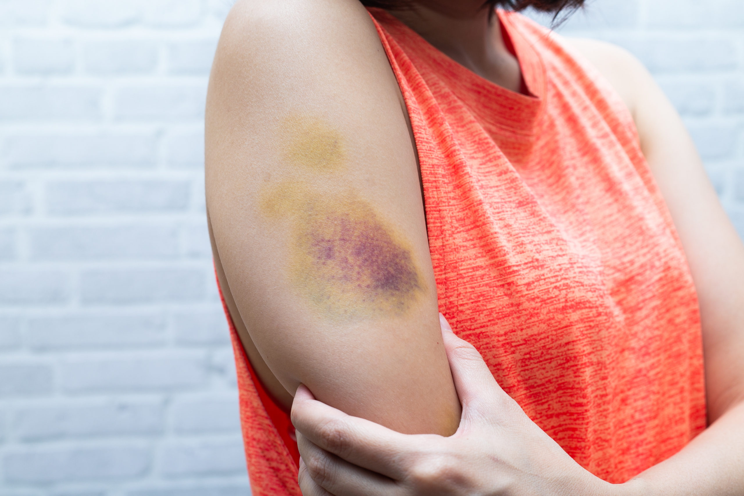 How long does it take for a bruise to form: visual explanation