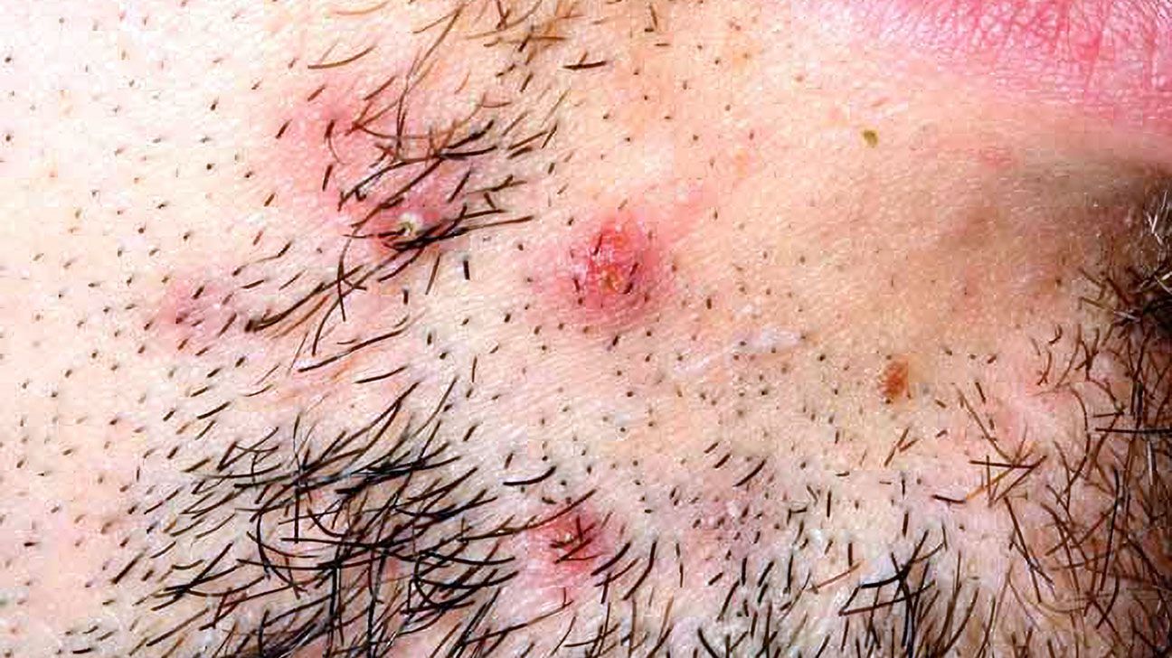 How long does a razor rash last: example and key details