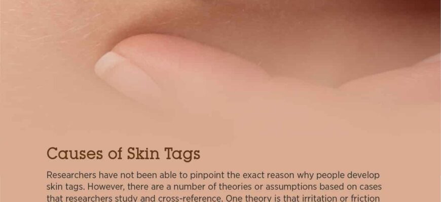 Skin-Tags-1