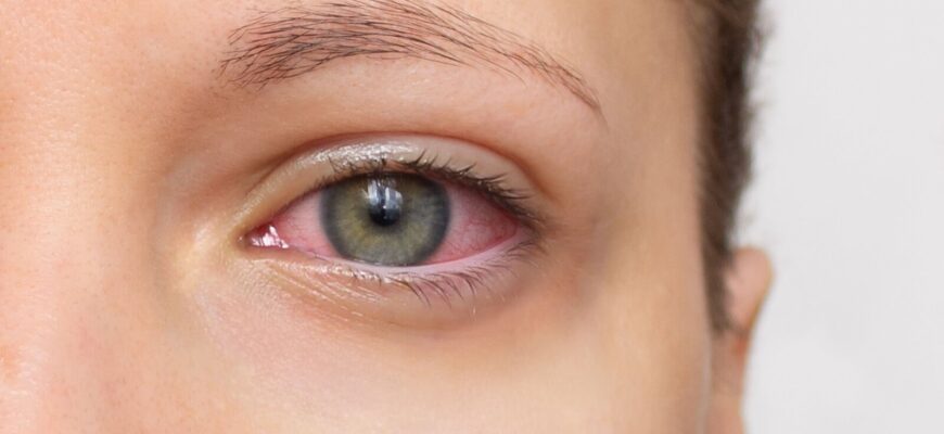 Why-Do-My-Eyes-Sting-When-I-Cry__supporting-2-1