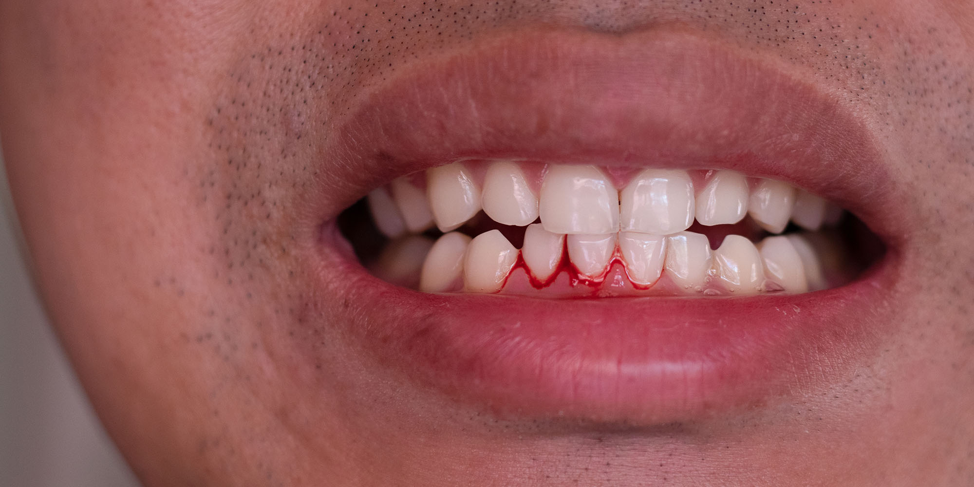 Why do my teeth bleed when i brush my teeth: visual explanation