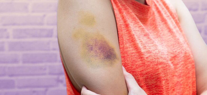 bruise-GettyImages-1059076258-25904d34b90544e7bc58bd6d1ec4d47f