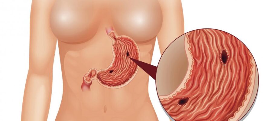 gastrointestinal-perforation