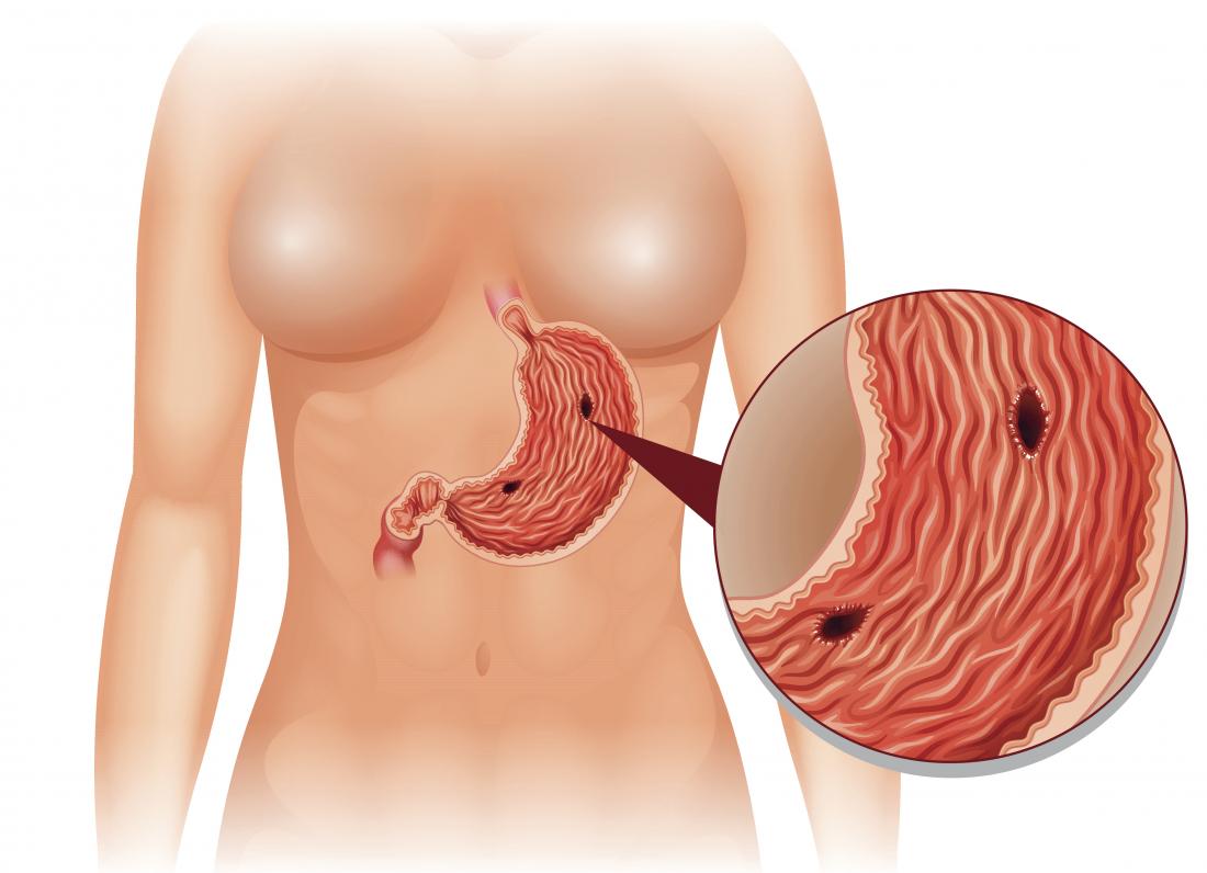 What causes perforation of the bowel: main illustration