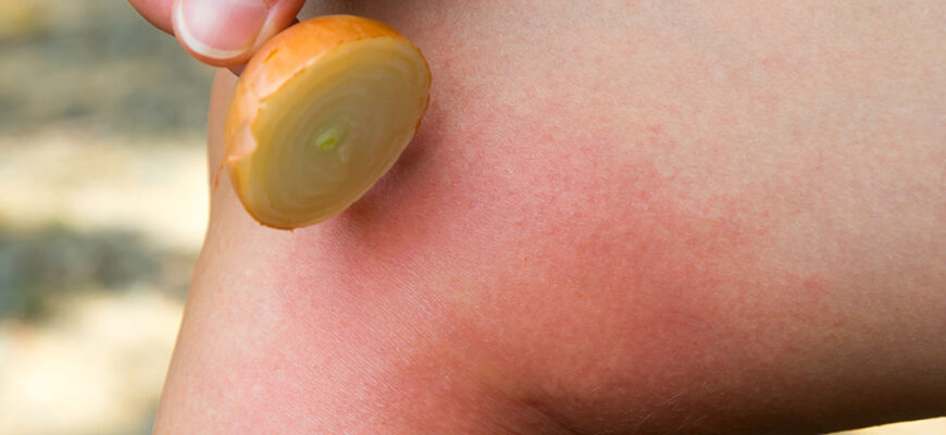 how-to-treat-bee-stings-hero