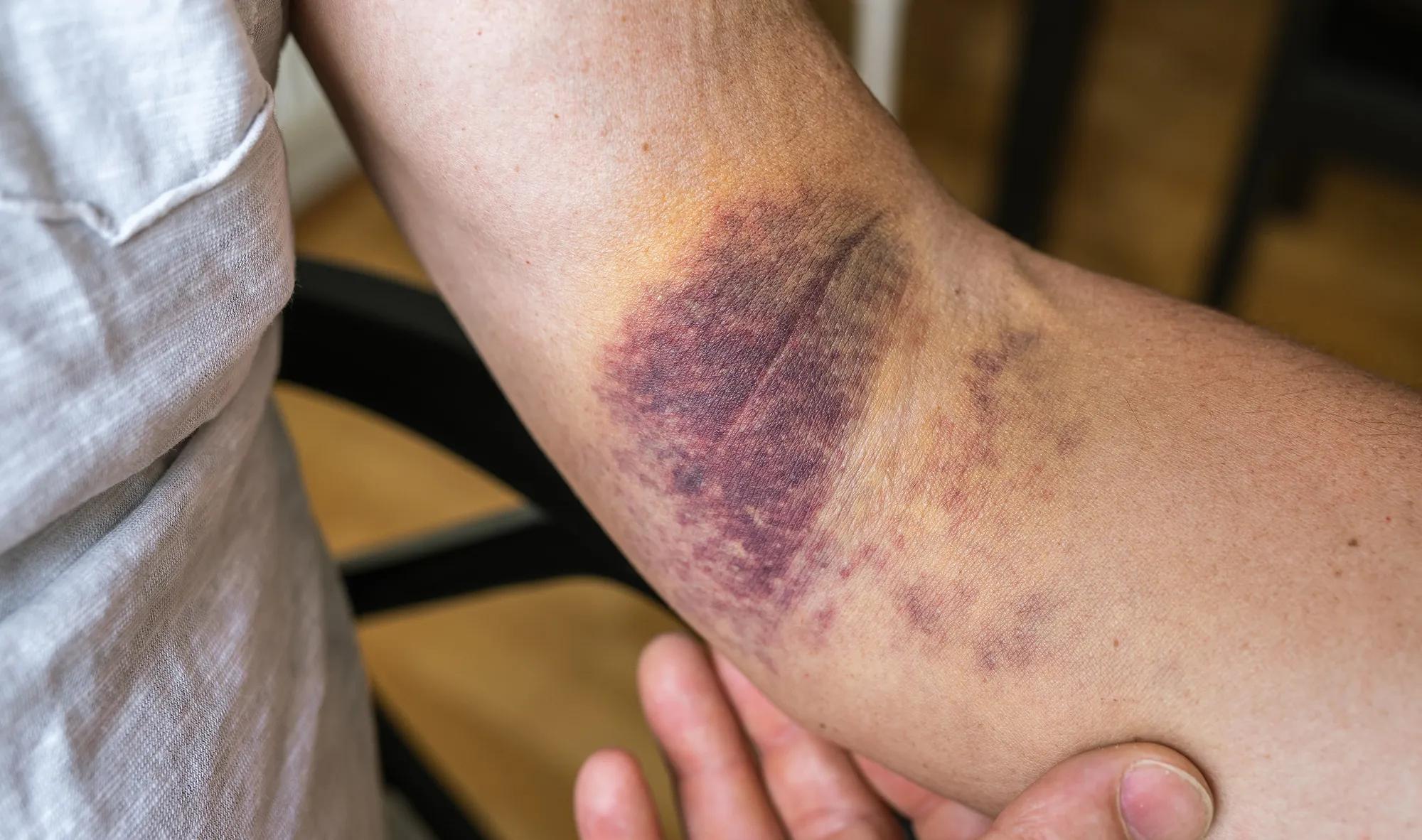 Why do bruise easily: example and key details
