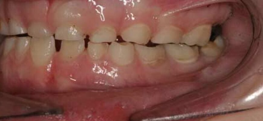 kids-teeth-grinding-apnea-1200x900