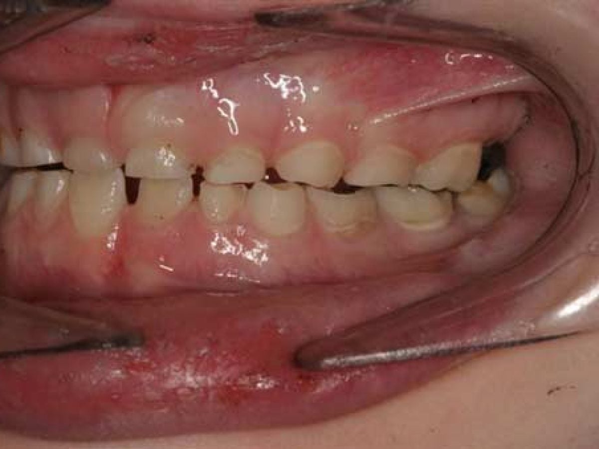 Why do i grind my teeth in sleep: main illustration