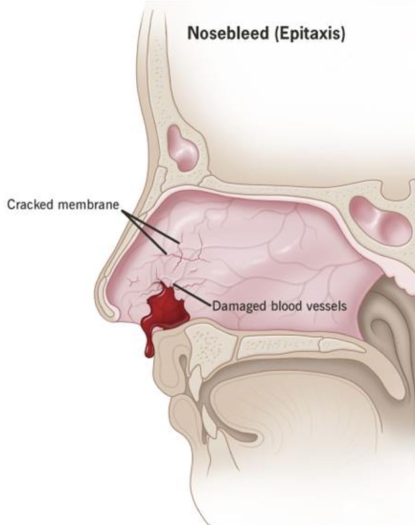 Why does nosebleed happen: visual explanation