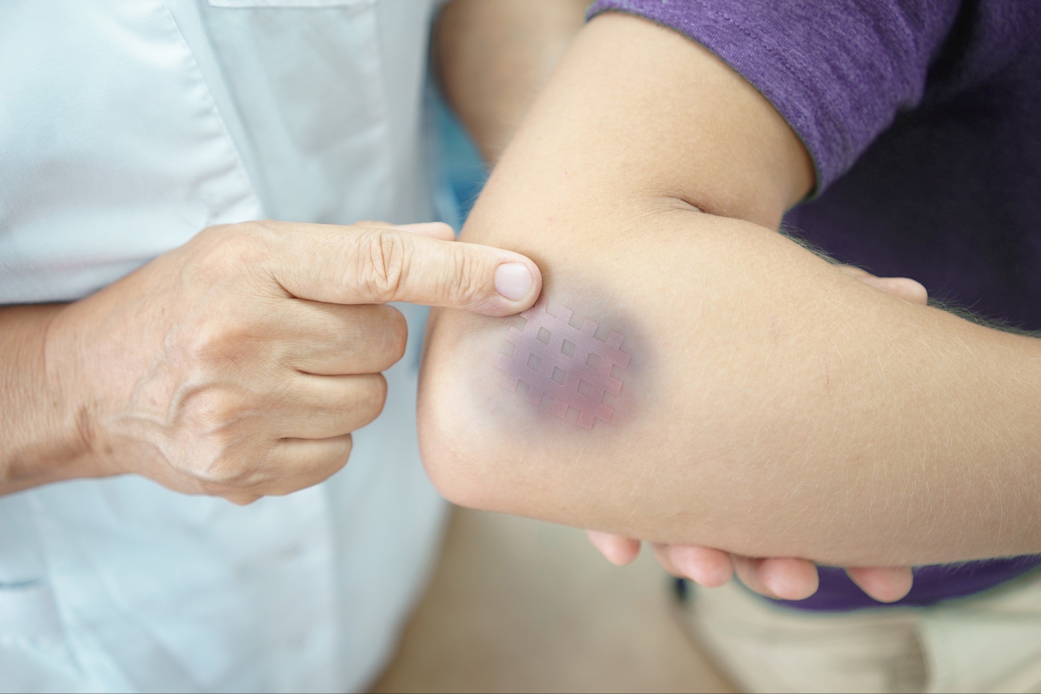 How long does it take for bruises to go away: visual explanation