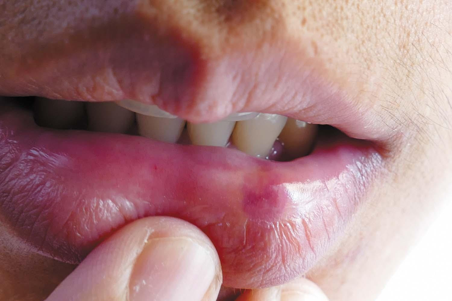 Why does my lips burn: visual explanation