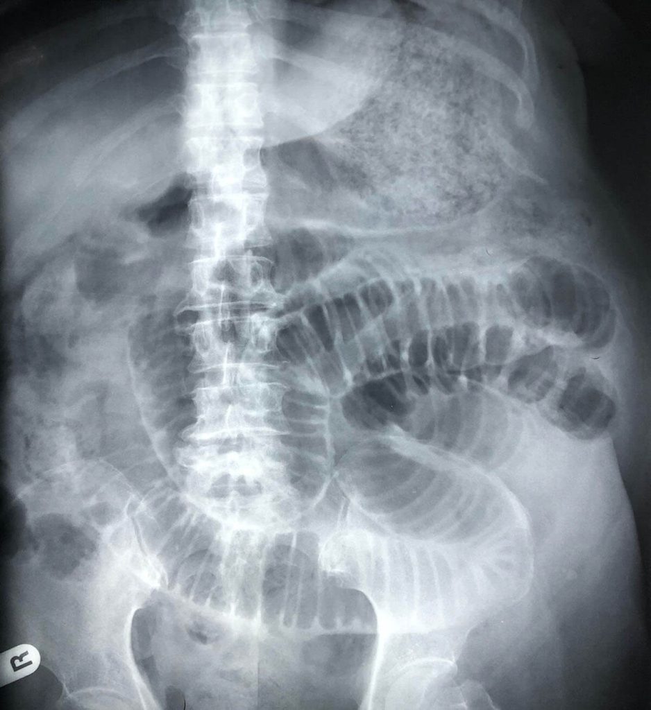 What causes perforation of the bowel: example and key details