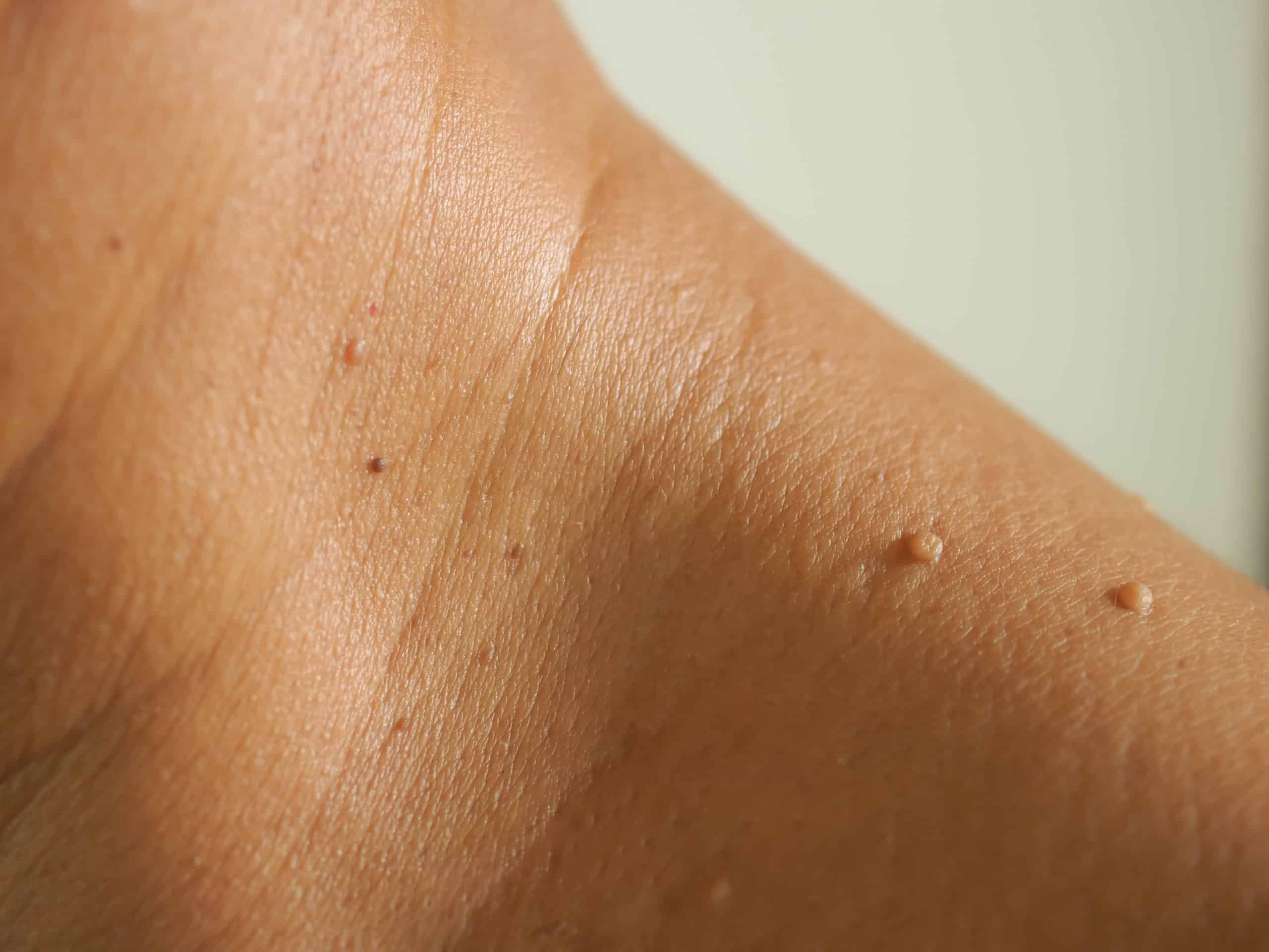 Why do i get skin tags: visual explanation