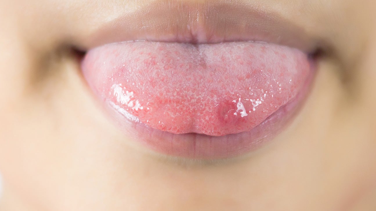 What causes a sore tongue: example and key details