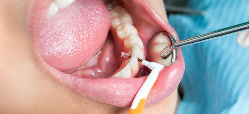 teeth-cleaning-time