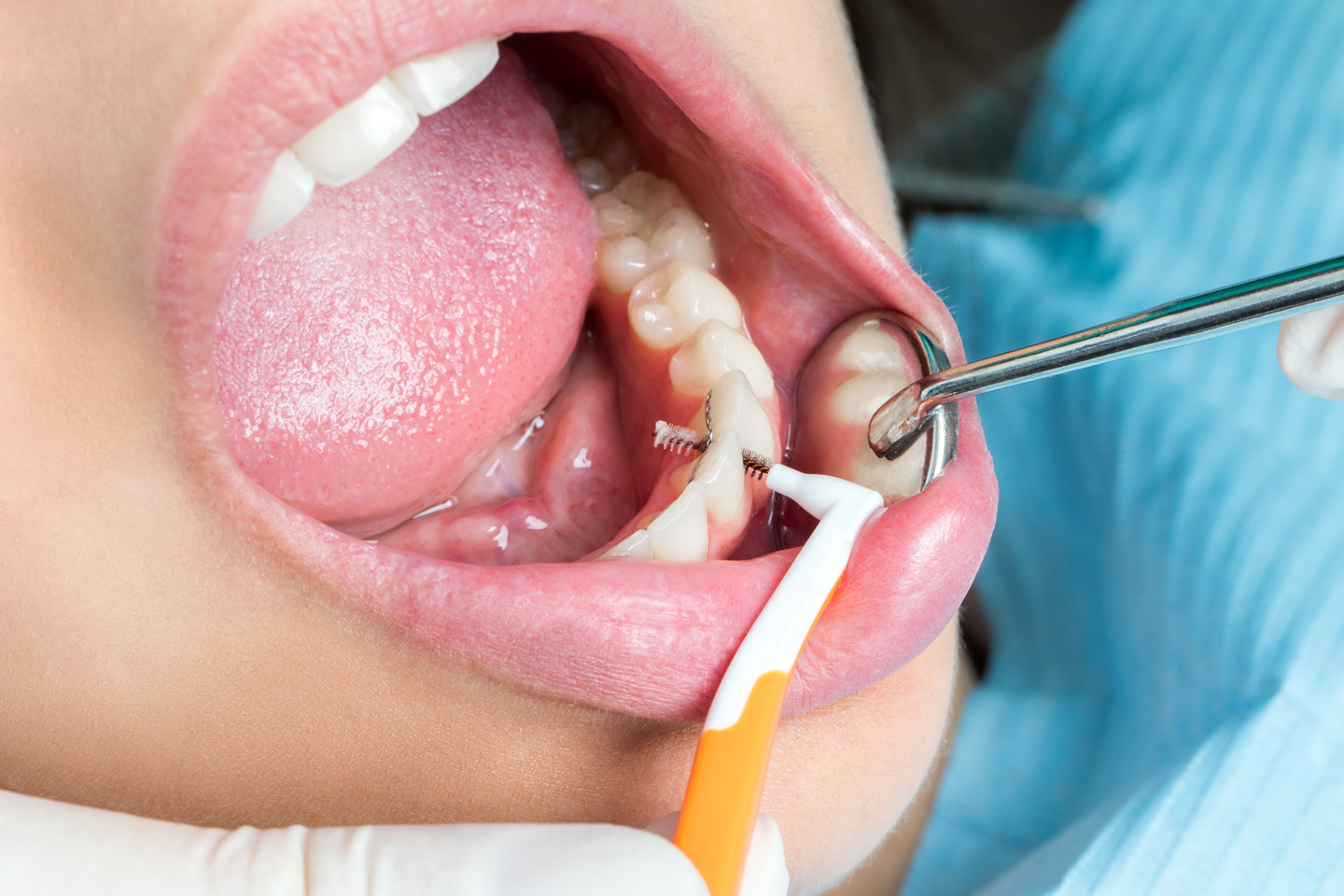 How long do teeth cleanings take: main illustration