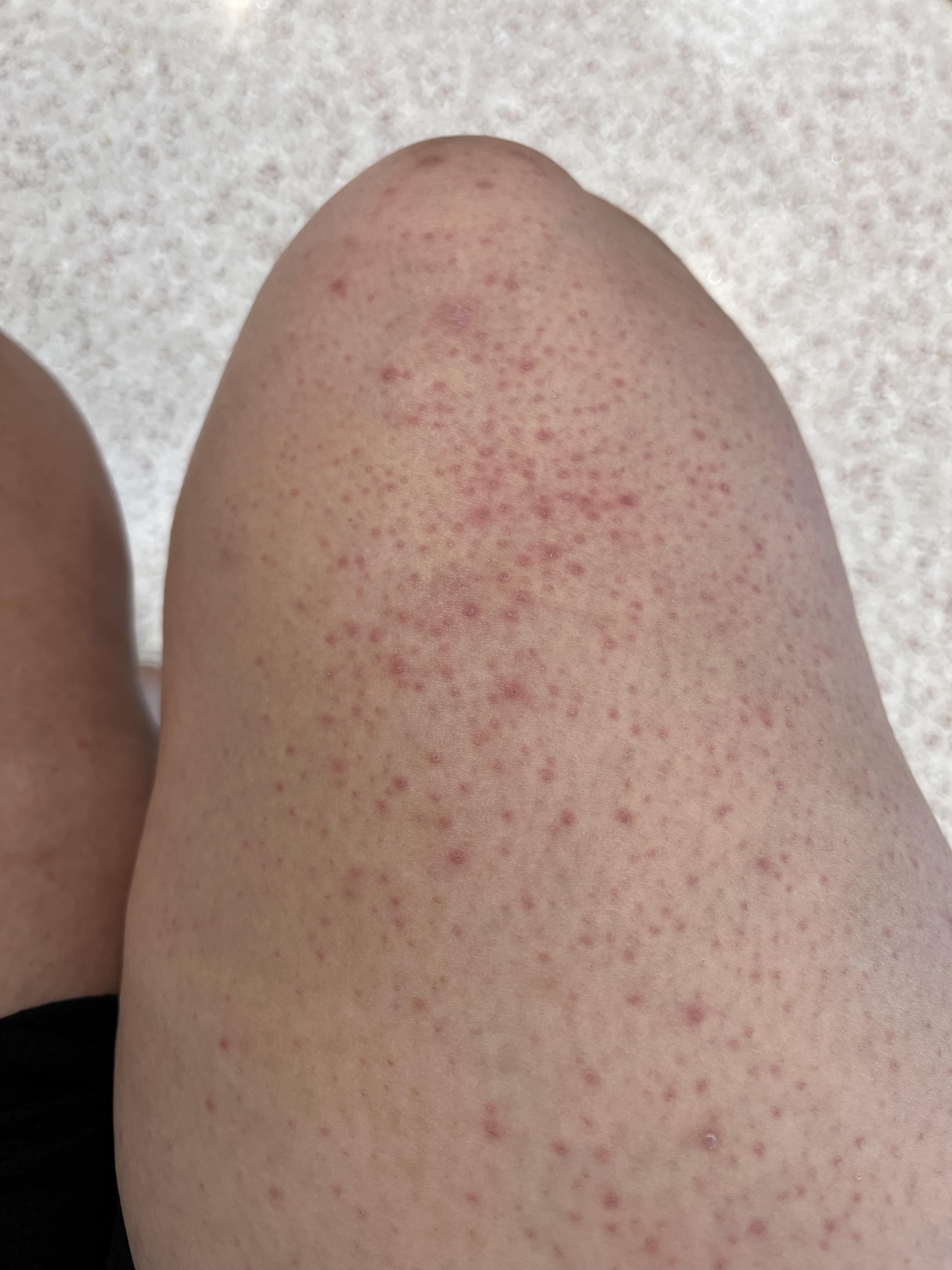 How long does a razor rash last: visual explanation