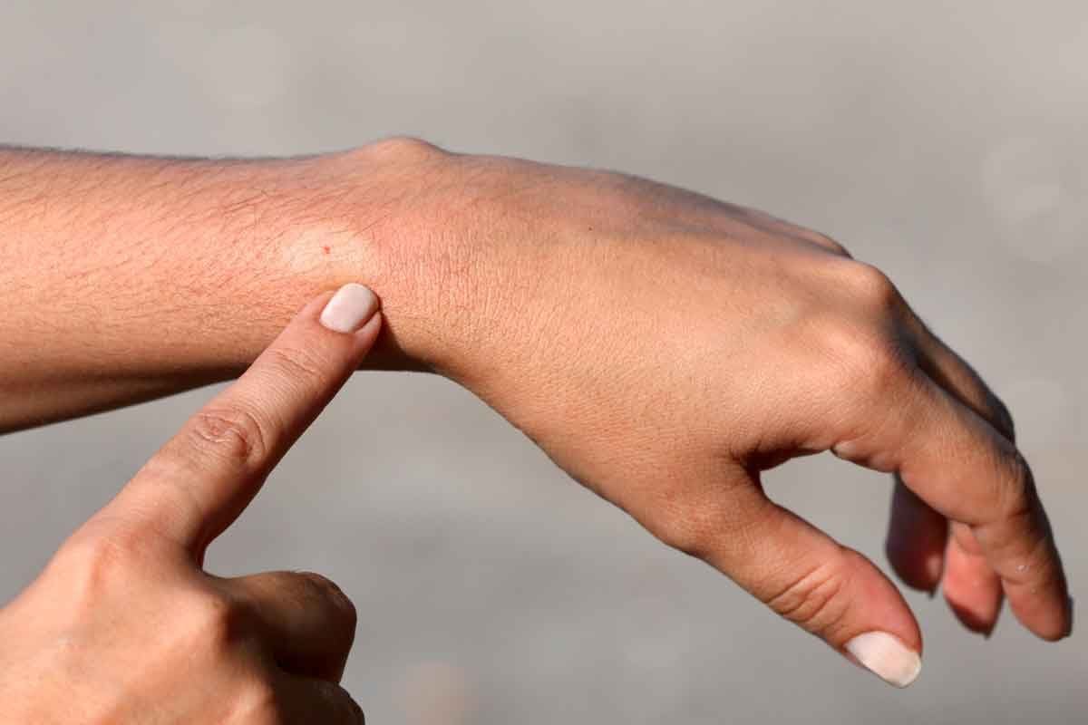 What to do if you get stung by a wasp: visual explanation