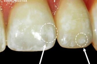 white-spots-on-teeth-causes-treatment-prevention
