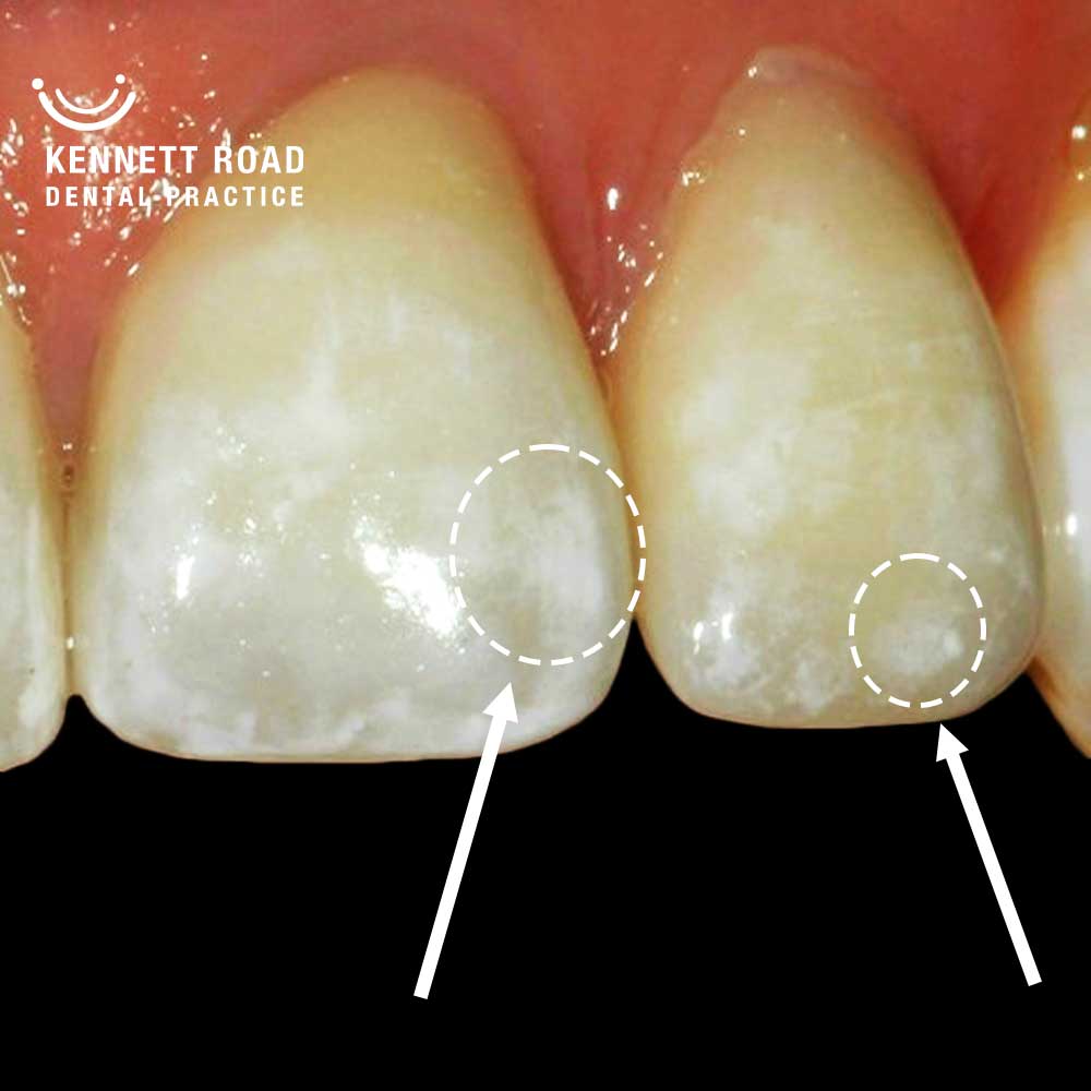 Why do my teeth have white spots: main illustration