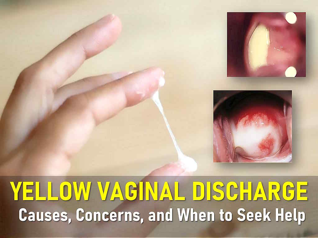 Is it normal for discharge to be yellow: visual explanation